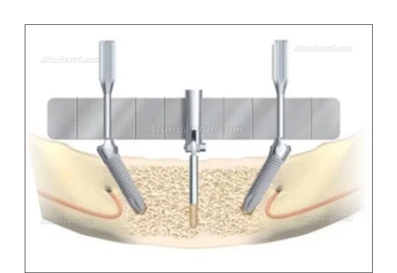 Dental Implant Surgical Guide Bendable Dental Implant Locating Guide Angle Rulers